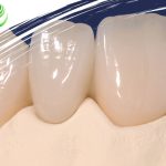انتخاب بلوک سرامیکی در دندان پزشکی